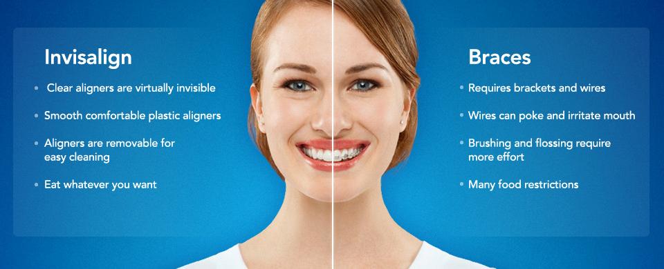 invisalignbraces