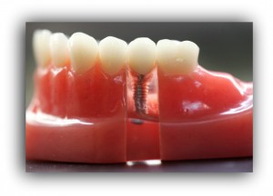 implant-dentistry