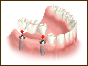 implant_bridge