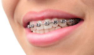 West Vancouver Orthodontics