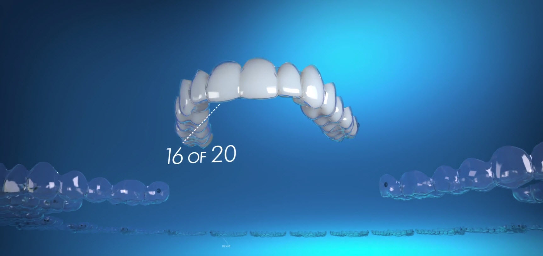 invisalign-video-scsh-2